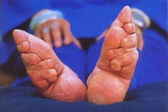 Foot Binding